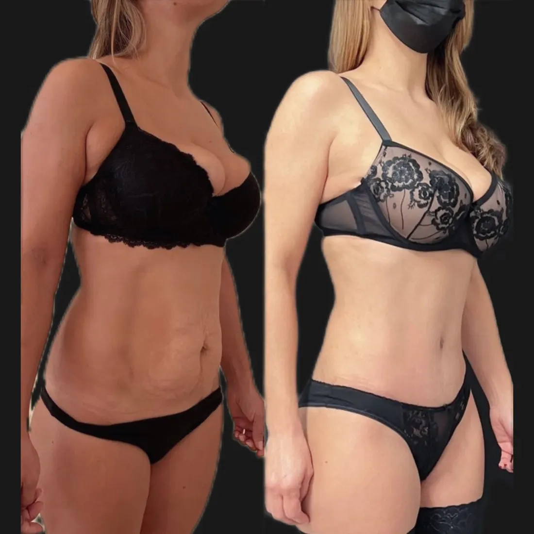 Liposuction