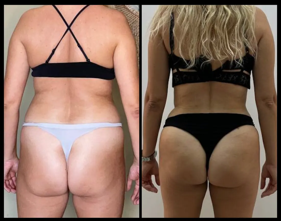 До и после: Липоабдоминопластика