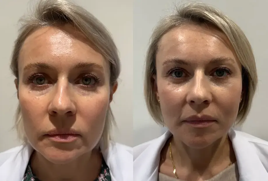 Deep Plane Facelift