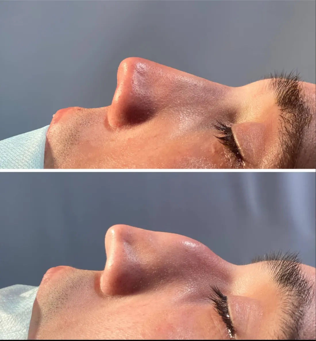 Rhinoplasty
