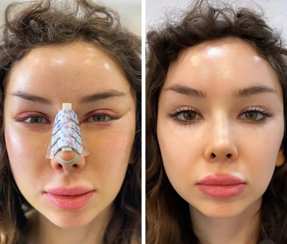 Before and after: Нижняя блефаропластика и риносептопластика