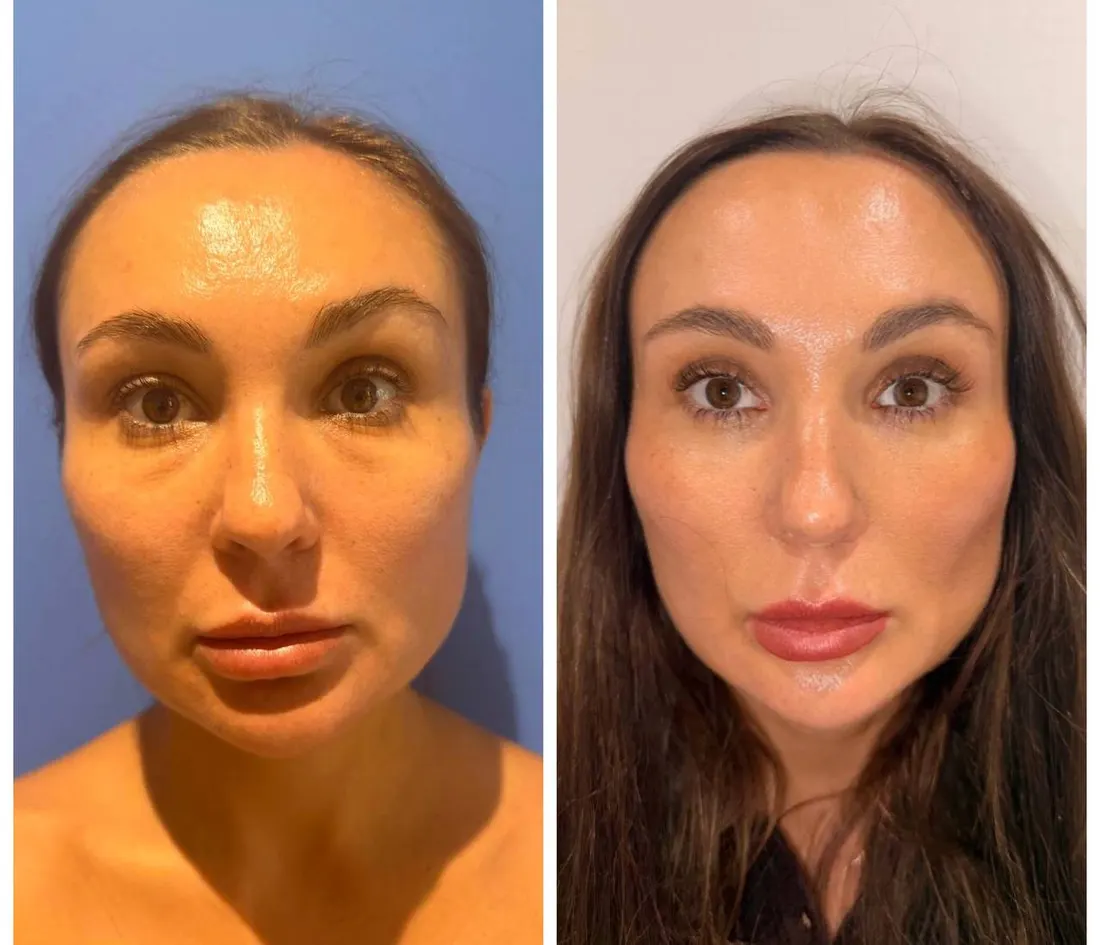 Before and after: Нижняя блефаропластика