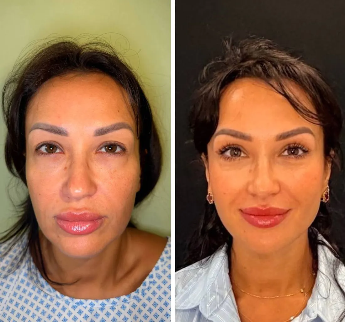 Upper & lower eyelid surgery
