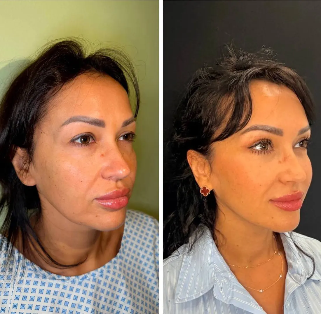 Before and after: Круговая блефаропластика