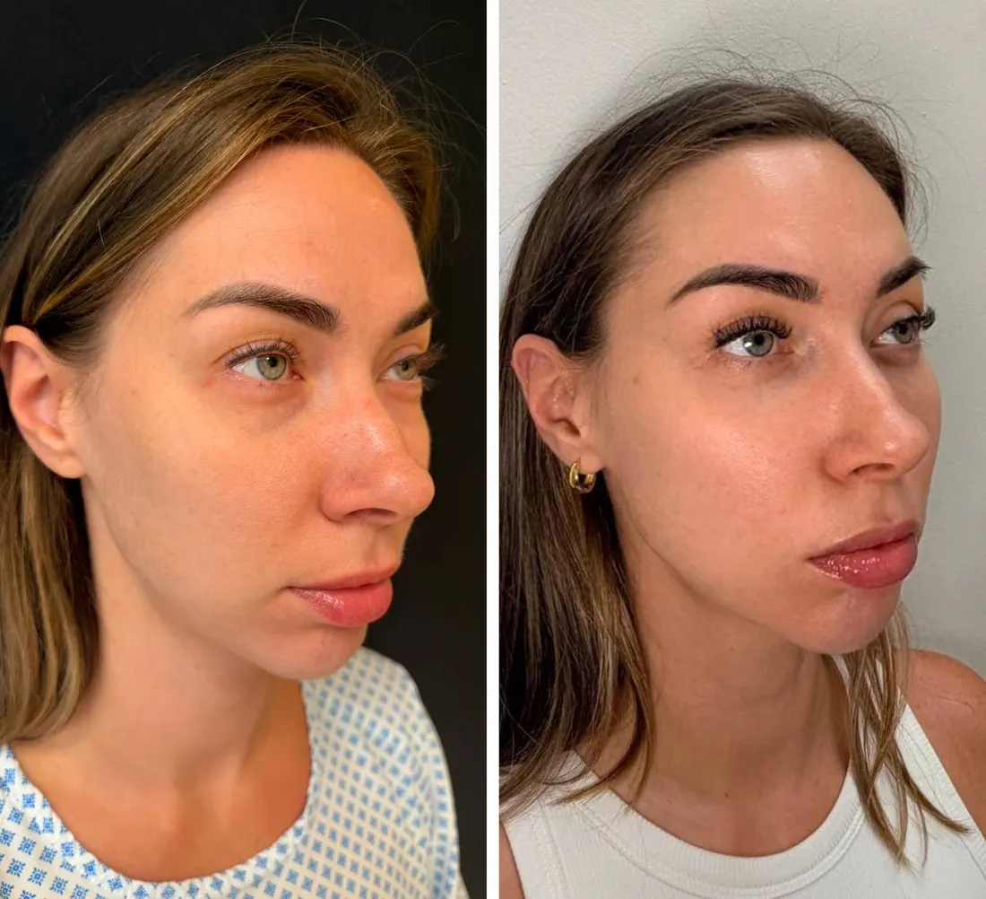 Before and after: Нижняя трансконъюнктивальная блефаропластика