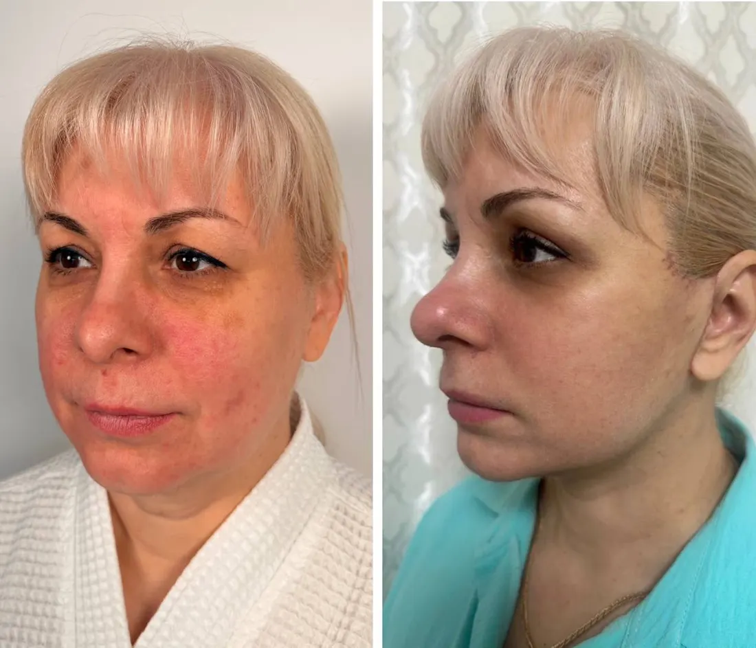 До и после: Full Face — комплексное омоложение