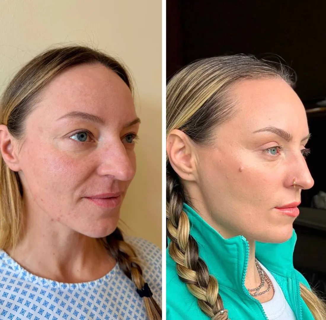 Before and after: Верхняя блефаропластика